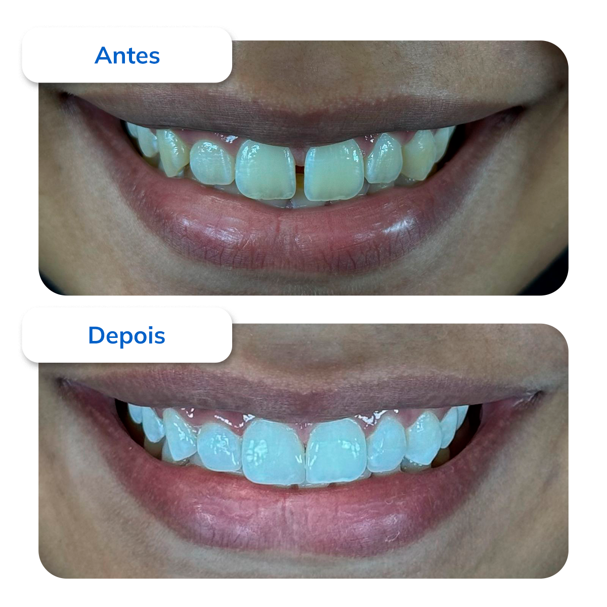 Clareamento Dental